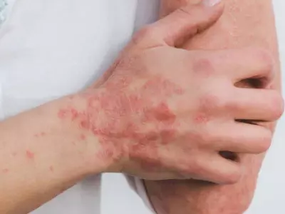 50% prueba dermatitis, psoriasis, picor de la piel